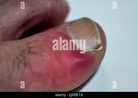 Infection à côté de l'ongle, dans le pied d'un patient Banque D'Images