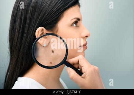 Femme avec loupe montrant la mole et le symbole de naissance sur son corps pour la prévention du mélanome et l'examen de nevus. Mole dermoscopie Banque D'Images