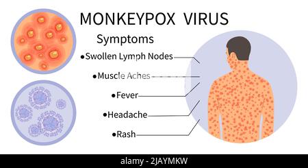 Bannière du virus de la variole du singe pour la sensibilisation aux symptômes. Infographie sur les symptômes du virus de la variole du singe. Corps humain avec éruption cutanée. Symptômes de la maladie - lymphe gonflée Illustration de Vecteur