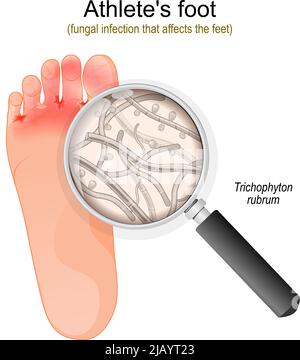 Pied de l'athlète. Infection fongique qui affecte les pieds. Gros plan des champignons de Trichophyton rubrum. Illustration vectorielle Illustration de Vecteur