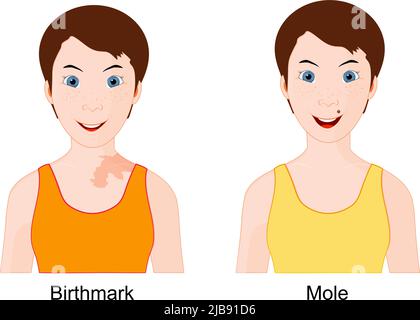 Mole et marque de naissance. Comparaison et différence par exemple de deux jeunes filles souriantes. Illustration vectorielle Illustration de Vecteur