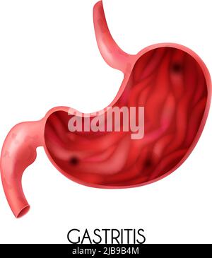 Image médicale réaliste de l'estomac humain avec gastrite sur fond blanc illustration vectorielle Illustration de Vecteur