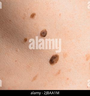 Mole de la peau sur le corps humain. Nævi brun ou nævus sur la peau du dos. Vérifiez le concept moles. Gros plan Banque D'Images