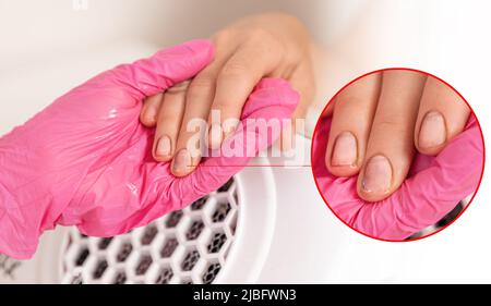 Manucuriste en gants médicaux roses tient la main d'un client avec des ongles sales et douloureux. Gros plan. Le concept des problèmes et des dommages fongiques de l'ongle. Banque D'Images