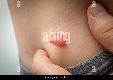 Gros plan photo d'une étiquette ou d'une mole cutanée sur un corps humain gonflée et élargie par le traitement dermatologue médical avec de l'azote liquide. Mole de la peau Banque D'Images