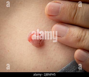 Gros plan photo d'une étiquette ou d'une mole cutanée sur un corps humain gonflée et élargie par le traitement dermatologue médical avec de l'azote liquide. Mole de la peau Banque D'Images