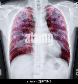 Fusion des rayons X du thorax avec l'image de rendu Lung 3D pour le diagnostic TB, TB et Covid-19 de CT-scanner 3D. Banque D'Images