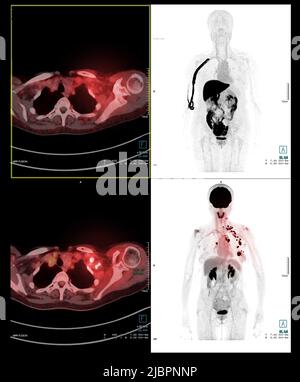 PET Scan image de tout le corps humain pour détecter la récidive du cancer après la chirurgie. Concept de technologie médicale. Banque D'Images