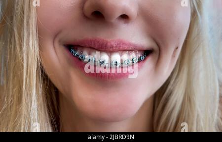 Dents avec bretelles. Concept de soins dentaires. Gros plan d'un grand sourire d'une fille avec des bretelles sur des dents blanches. Le concept de soins dentaires et oraux Banque D'Images