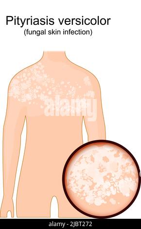 Tinea versicolor. Corps humain présentant des symptômes de la pityriasis versicolor. Gros plan de la peau affectée par un champignon. Illustration vectorielle Illustration de Vecteur