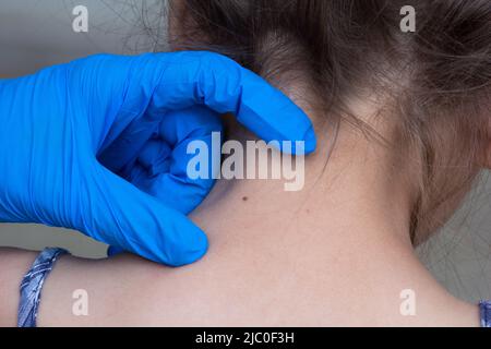 Femme écourtée mains en gants médicaux montrant le symbole de naissance sur le cou de l'enfant dos Banque D'Images