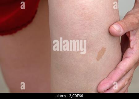 Les mains des femmes écourtées montrent un grand symbole de naissance sur la jambe Banque D'Images