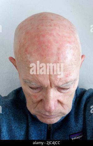 Homme, 71, patient, tête, chauve, Visage, avec des dommages légers, kératose actinique, immédiatement après la thérapie photodynamique (PDT), traitement laser, laqué Banque D'Images