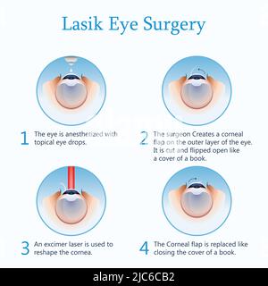 Chirurgie oculaire LASIK. Illustration vectorielle Illustration de Vecteur