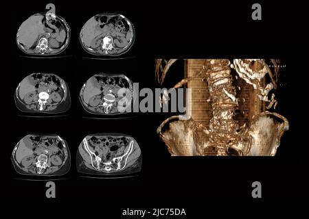 tomodensitométrie de la colonne vertébrale avec une fracture des vertèbres et leur déplacement d'une personne taorogo, fracture des vertèbres avec l'effort Banque D'Images