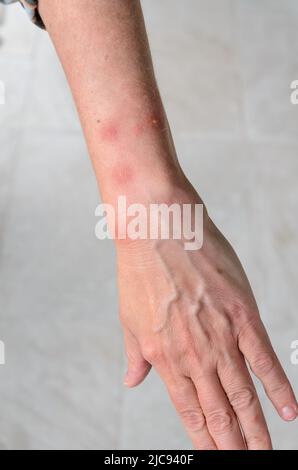 Réaction allergique aux piqûres d'insectes avec des taches de gonflement rondes sur le bras d'une femme Banque D'Images