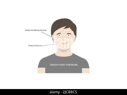 Illustration vectorielle du syndrome de la chasse de ramsay. Trouble caractérisé par une paralysie du nerf facial et une éruption vésiculaire affectant l'oreille ou la bouche. Illustration de Vecteur