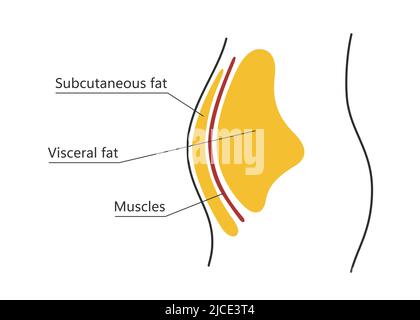 Graisse viscérale et sous-cutanée autour de la taille. Emplacement de la graisse viscérale dans la cavité abdominale. Types d'obésité humaine. Régime médical. Vecteur Illustration de Vecteur