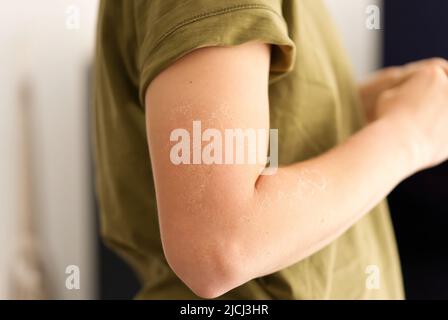 peeling de la peau à l'épaule de l'effet de coup de soleil sur le corps de la jeune femme. Fille avec le concept de peau rouge coup de soleil Banque D'Images