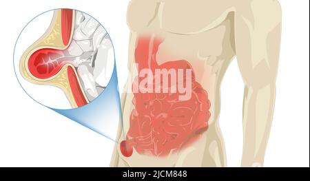 Zoom avant sur la hernie inguinale Banque D'Images
