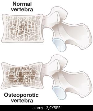 Illustration montrant l'ostéoporose, la vertèbre normale et la vertèbre ostéoporotique. Illustration étiquetée Banque D'Images