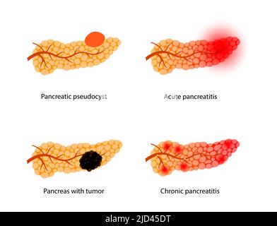 Maladies pancréatiques, illustration Banque D'Images