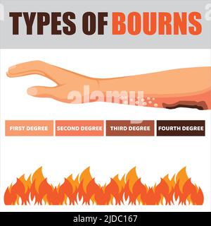 Infographie sur les étapes et le traitement des lésions dues aux brûlures cutanées. Dommages causés par un incendie. Peau rouge. Illustration vectorielle isolée en style de dessin animé Illustration de Vecteur