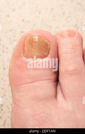 Toenails avec infection fongique et ecchymoses sur gros orteil macro Banque D'Images