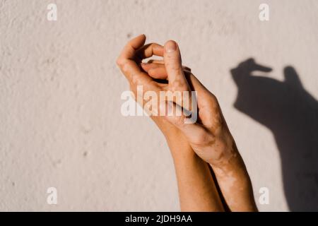 Pigmentation de peau de vitiligo sur les mains de la femme. Maladies saisonnières de la peau Banque D'Images