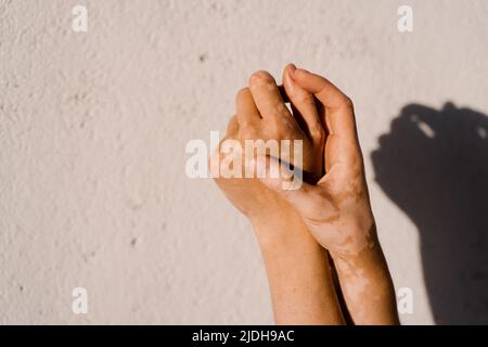 Pigmentation de peau de vitiligo sur les mains de la femme. Maladies saisonnières de la peau Banque D'Images