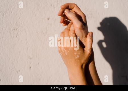 Pigmentation de peau de vitiligo sur les mains de la femme. Maladies saisonnières de la peau Banque D'Images