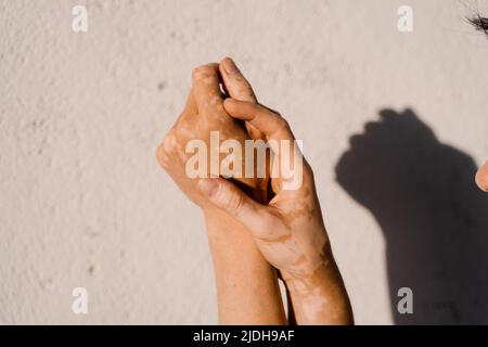 Pigmentation de peau de vitiligo sur les mains de la femme. Maladies saisonnières de la peau Banque D'Images