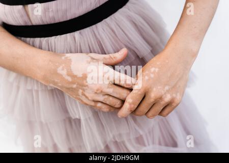 Mains avec pigmentation de peau de vitiligo. Style de vie avec les maladies saisonnières de la peau Banque D'Images