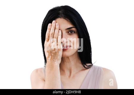 La femme géorgienne avec des timbres de pigmentation de vitiligo sur les mains couvre son visage avec ses mains. Style de vie avec les maladies saisonnières de la peau Banque D'Images