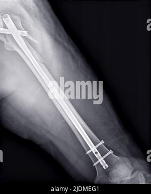 Fracture osseuse du fémur à rayons X après le remplacement de la hanche et du fémur totaux. Banque D'Images