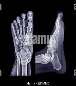 Image radiographique du pied vue AP et latérale isolée sur fond noir. Banque D'Images