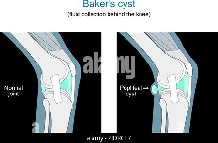 Collecte de liquide kyste de Baker derrière le genou. Coupe transversale de l'articulation humaine. Diagramme vectoriel plat comme l'illustration des rayons X. Illustration de Vecteur