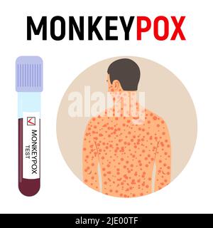 Pandémie de la variole du singe. Un tube à essai avec du sang pour un test et un homme avec une éruption cutanée sur son corps est malade avec la variole. Symptômes de la maladie. Illustration vectorielle. Illustration de Vecteur