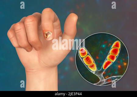 Illustration d'une infection fongique des ongles montrant la main humaine avec onychomycose et vue rapprochée des champignons d'Epidermophyton floccosum, l'un des agents responsables des infections des ongles. Banque D'Images