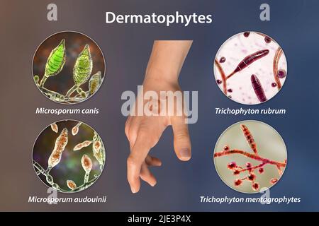 Infection fongique sur la main d'un homme, illustration. Connu sous le nom d'infection de ver à anneau, ou tinea manuum. Elle peut être causée par divers champignons, dont Microsporum canis, Microsporum audouinii, Trichophyton rubrum et Trichophyton mentagrophytes. Il provoque de fortes démangeaisons. La maladie est très contagieuse et peut se propager par contact direct ou par contact avec du matériel contaminé. Le traitement est avec des médicaments antifongiques. Banque D'Images