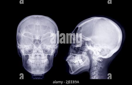 Image radiologique du crâne de l'AP humain et vue latérale isolée sur fond noir. Banque D'Images