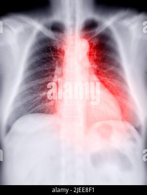 Radiographie thoracique pour le dépistage de la tuberculose, de la tuberculose et du covid-19. Banque D'Images