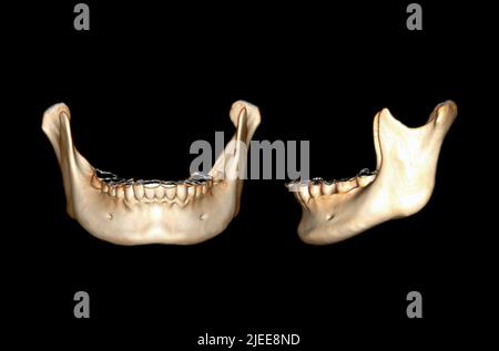ACQUISITION CT de l'image de rendu de l'os mandibule 3D isolée sur fond noir. Masque Banque D'Images