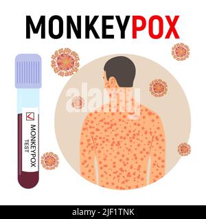 Affiche sur la pandémie de variole du singe. Antivariolique, tube à essai avec du sang avec un test positif et des cellules virales. Maladie virale. Illustration vectorielle. Illustration de Vecteur