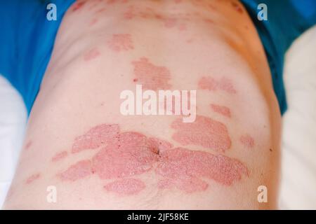 Grande éruption cutanée rouge enflammée et squameuse sur l'estomac. Psoriasis aigu sur l'estomac chez un homme, rougeur sévère sur la peau, une maladie auto-immune incurable Banque D'Images