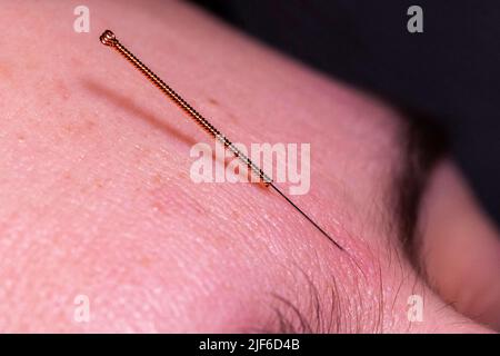 Un portrait macro d'une petite aiguille d'acupuncture qui colle dans la tête avant du visage d'une personne entre les sourcils, pour soulager le stress, guérir la douleur ou ano Banque D'Images