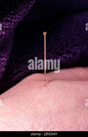 Un portrait d'une petite aiguille d'acupuncture qui colle directement dans la peau de la main d'un patient, pour guérir la douleur ou un état de santé, ou pour le rel Banque D'Images