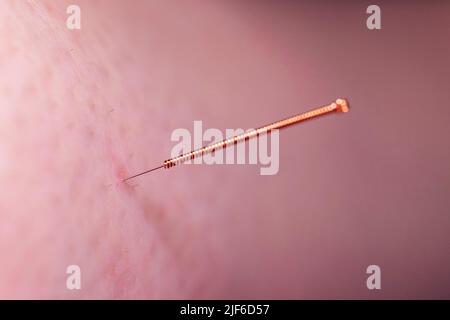 Une aiguille d'acupuncture qui colle à la peau d'un patient. La petite aiguille a une prise en cuivre et est percée profondément dans la peau pour soulager le stress an Banque D'Images