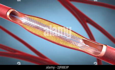 Implantation d'un stent pour soutenir la circulation sanguine dans les vaisseaux sanguins - illustration 3D Banque D'Images