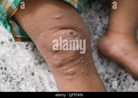 Infestation de gale avec infection bactérienne secondaire ou superposée et pustules dans la jambe de l'Asie du Sud-est, enfant birman. Banque D'Images